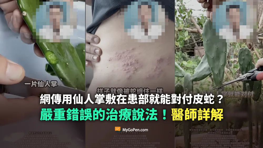 【錯誤】網傳用仙人掌敷在患部就能對付皮蛇的影片？嚴重不實的治療說法！醫師詳解